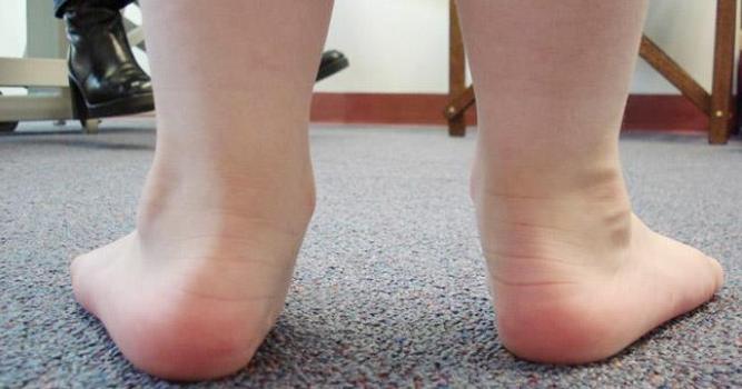 Упражнения при вальгусной деформации стопы у детей